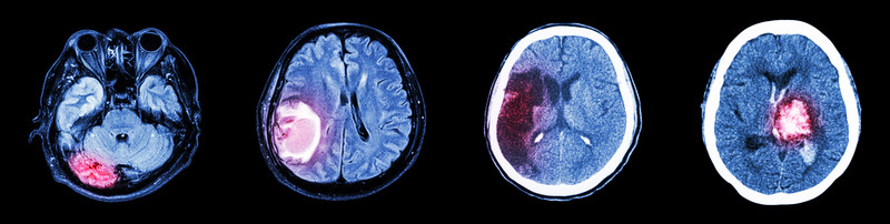 neuroimaging analyzing different chronic pains