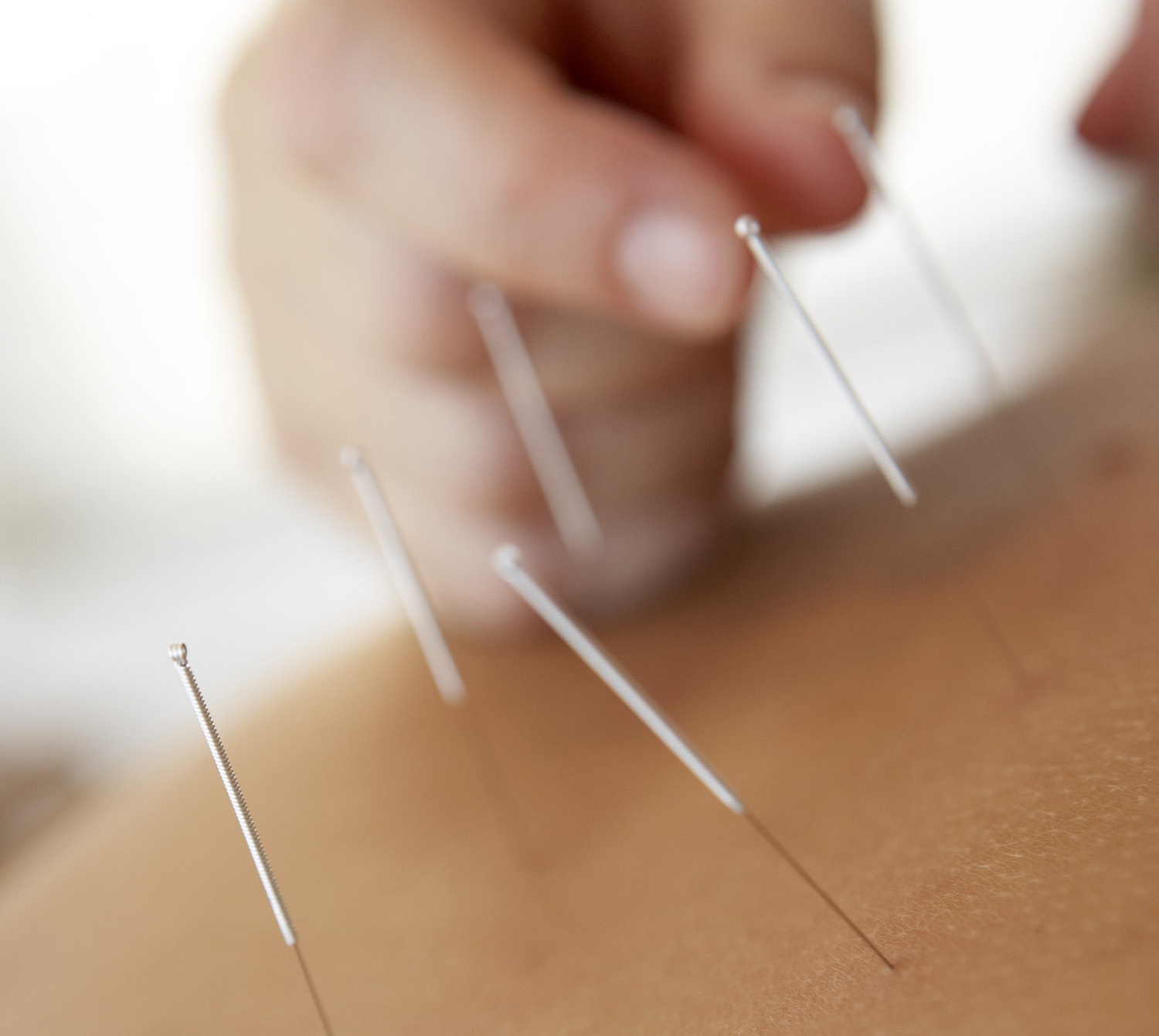 Acupuncture Relief Chronic Pains