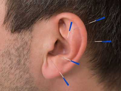 ear acupuncture help with chronic neck pain