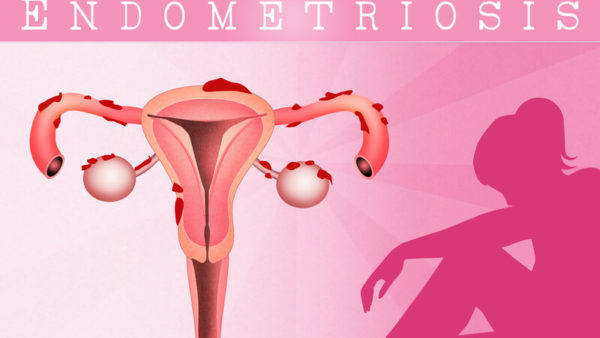dietary changes help endometriosis pain
